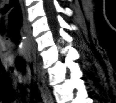 Osteoblastoma Soft Tissue CT